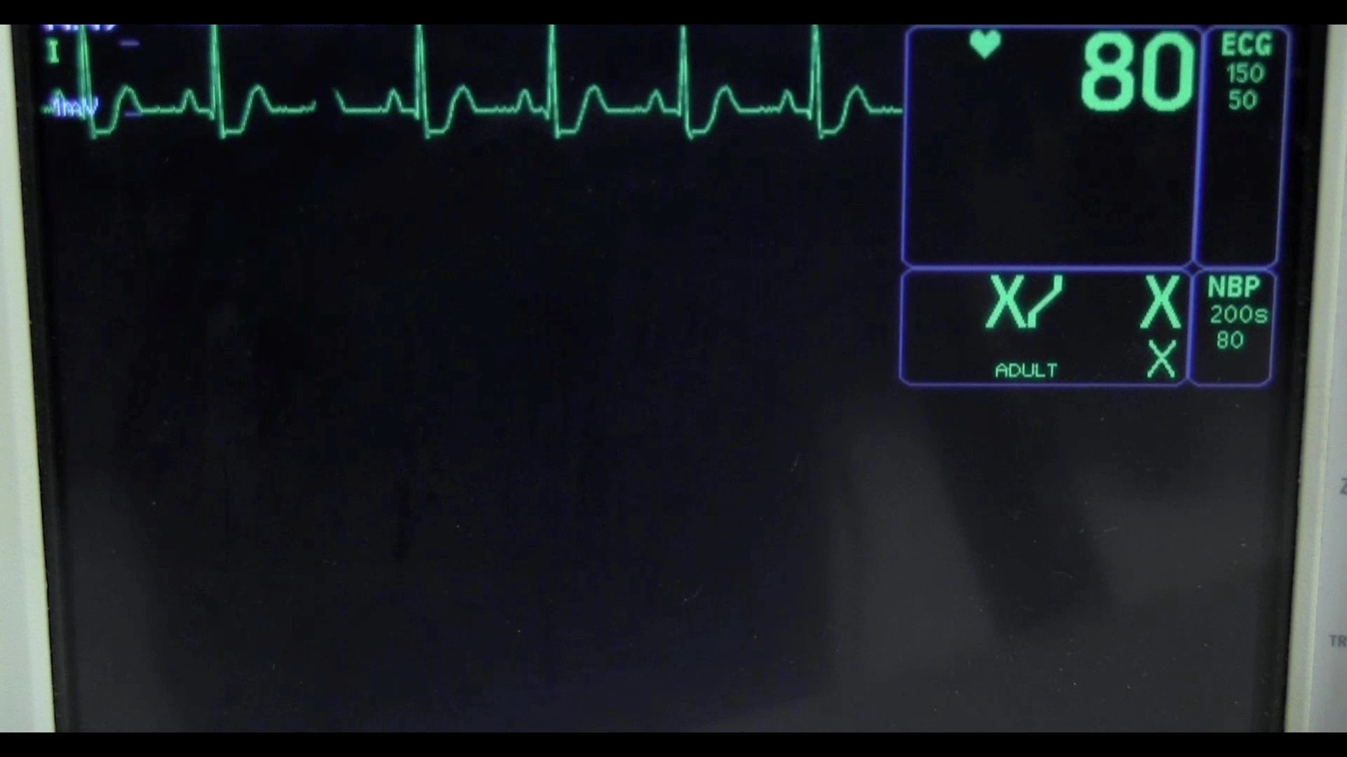 Central monitoring station display showing patient vitals becoming active after the ECG simulator is connected to the patient monitor